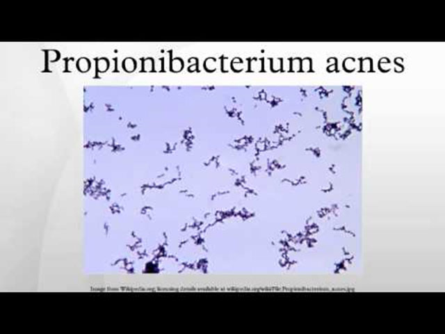propionibacterium-acnes